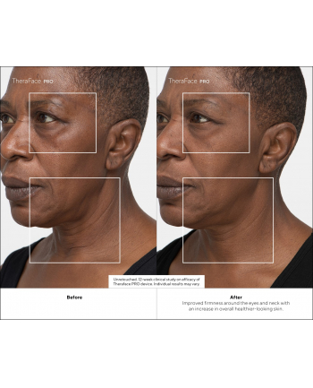 Urządzenie do terapii twarzy Therabody Theraface Pro czarny